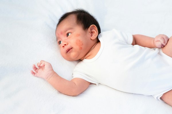 Eczéma bébé : comment choisir les meilleurs soins apaisants ?