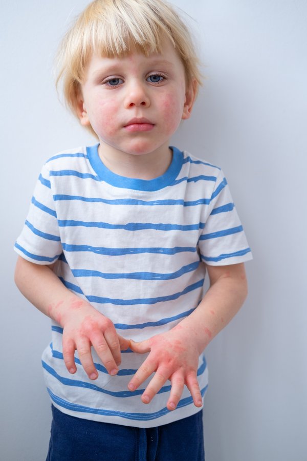 Les meilleurs soins apaisants pour l'eczéma chez les bébés